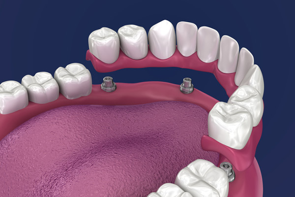 3D rendering of overdentures in a mouth at Jeanette Thai, DDS in Lake Forest, CA